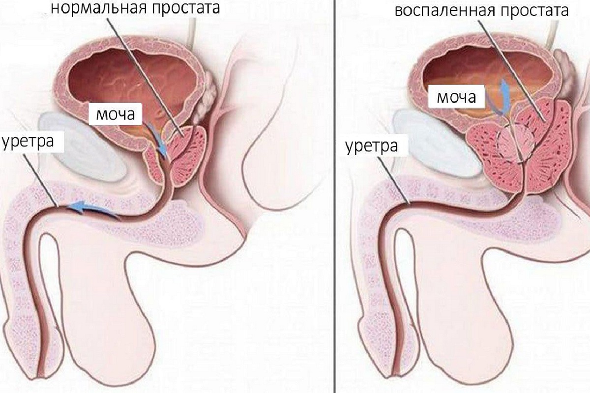 prostată sau prostatita)